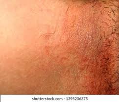 Image result for sore skin in the groin area