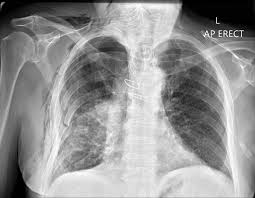 Image result for Emphysema