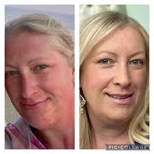 everyone Wasn't feeling well but m back 🥰💃💃Client had issues with  blackheads, enlarged pores, pimples, dark spots, dark circles and uneven  skin tone, so I recommended a 📌L&E R440 combo 💁Showing results