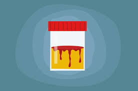 Kencing berdarah dalam istilah perubatan dipanggil sebagai hematuria. Urine Berdarah Akibat Hematuria Ini 3 Cara Mencegahnya