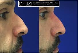 Check spelling or type a new query. Non Surgical Rhinoplasty Nyc Top Ranked Zuckerman Plastic Surgery