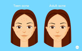 Best Birth Control Pills For Women With Hormonal Acne Mdacne