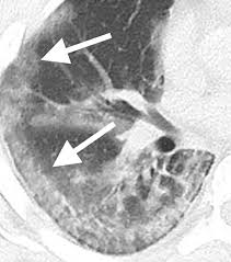 CT Imaging Features of 2019 Novel Coronavirus (2019-nCoV)Radiology
