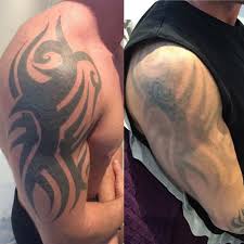 First, the size of the tattoo will definitely effect the pricing, the number of colors present in the tattoo and the density (volume) of the. Laser Tattoo Removal In Exeter Devon Radiance Aesthetic Clinic