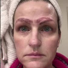 Wrong placement of brow tattoo; Missouri Woman S Botched Microblading Procedure Goes Viral Allure
