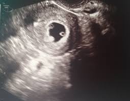 6 week ultrasound pictures twins. 6 Weeks 6 Days With Twins Glow Community