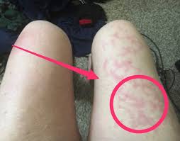 This is a common skin condition that can occur on your skin especially on hand, finger, foot, heel and ankle. Unusual Skin Symptoms Of Coronavirus Covid Toes Blisters