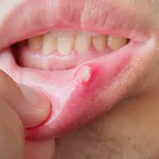 Image result for Mouth ulcers roof of mouth