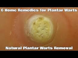 natural plantar warts removal