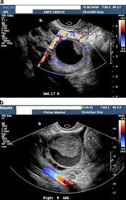 Image result for corpus luteum sonography)
