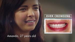 Most likely, your invisalign monthly cost will work out to be anywhere from $50 to $200 per month. Invisalign Cost Clearbraces Ie Find The Invisalign Price Package For You