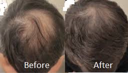 See the studies, photos, and answers. Shedding Microneedling 3 Best Ways To Stop Minoxidil Shedding Benefits Of Microneedling How To Prepare For Microneedling What To Expect From Microneedling