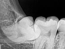 How much to get wisdom teeth removed vary from one practice to another. Wisdom Tooth Wikipedia