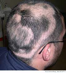What is known is that the inflammation occurs in the upper part of the hair follicle. Concentric Or Targetoid Regrowth In Alopecia Areata Actas Dermo Sifiliograficas