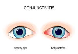 Conjunctivitis Pink Eye Causes And Real Treatments Nvision Eye Centers