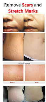 Bio Oil White Stretch Marks Before And After Pin On A Z About Herbal Medicine And Home Remedies