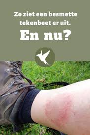 Een Tekenbeet Kan Je Zomaar Overkomen Het Gebeurt 1 3 Miljoen Mensen Per Jaar Teken Kunnen De Ziekte Van Lyme Overb Pijnbestrijding Gezondheid Fitness Gezond