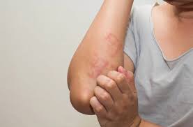 Image result for scabies on humans