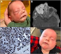 The Risk of Sympathetic Ophthalmia Associated with Open-Globe Injury  Management Strategies
