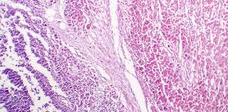Myocarditis is an inflammatory disease of the myocardium with a wide range of clinical presentations, from subtle to devastating. True Myocarditis Uncommon In Covid 19 Review Concludes Tctmd Com