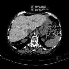 Hepatic Attenuation On Ct Radiology Reference Article Radiopaedia Org