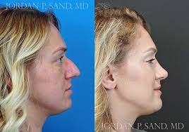 This beautiful patient never liked her nose. She felt it was too prominent  for her and very crooked. She also had a lot of difficulty breathing  through the nose. She wanted it