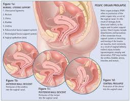My Personal Prolapse Story Discovery To Recovery Pelvic Organ Prolapse Pelvic Organ Prolapse Surgery Bladder Prolapse