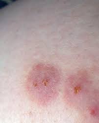 Spider Bites That Look Like Mosquito Bites These Pictures Will Help You Id The Most Common Bug Bites This Summer In 2020 Bed Bug Bites Pictures Bug Bites Bed Bug Bites