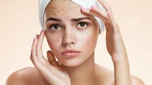 If you have hormonal acne (and especially if you have pcos) you will definitely want to consider eliminating dairy. How To Treat Hormonal Acne Top 10 Home Remedies