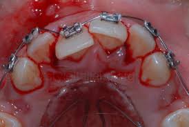 Image result for Tooth Luxation