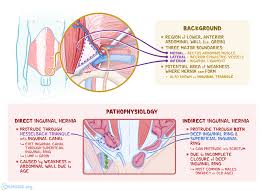 The location of the groin area is at the crease lines where the legs meet the abdomen. Hesselbach Triangle What Is It Location And More Osmosis