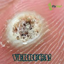 Image result for verrucae filiformes