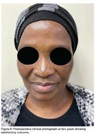 A gigantic unilateral neck mass in the submandibular region