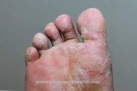 فطريات الجلد الأسباب والأعراض والعلاج الأمراض