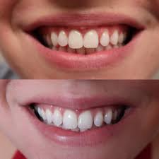 Guaranteed 2 shades whiter in just 2 weeks. How I Whitened My Teeth At Home With Smile Brilliant It S Megan Lifestyle Blog