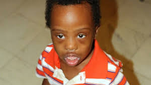 Life expectancy for people with down syndrome varies depending on race, but why? Ok Families Worry About The Future Of Medicaid Health Care For People With Disabilities Kokh