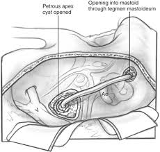 We studied trautmann's triangle anatomy and its area in transpetrosal approaches. Drainage Procedures For Petrous Apex Lesions Ento Key