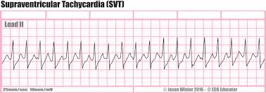 Stands for special vehicle team, from ford. Ecg Educator Blog Supraventricular Tachycardia Svt