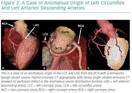 How to use anomalous in a sentence. Diagnosis And Management Of Anomalous Coronary Arteries With A Malignant Course Icr Journal