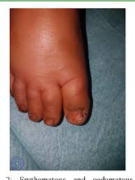 Image result for erysipel photos)