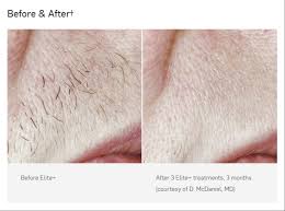 Larger areas of hair removal, like the back or chest, may take an hour or. Laser Hair Removal Duluth Ga Bella Forma