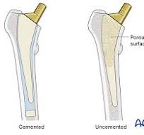 Hemiarthroplasty for Transcervical shear fractures of the ...