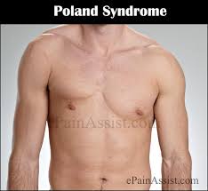 Typically the right side is involved. What Is Poland Syndrome Features Causes Treatment Prognosis Epidemiology