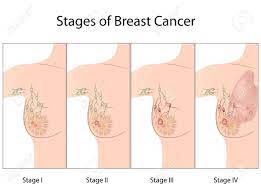 Stages Of Breast Cancer Royalty Free Cliparts Vectors And Stock Illustration Image 15357008