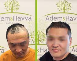 Before And 3 Months After Hair Transplantation Hello To All Members Of Adam Havva Clinic I Would Like T Hair Transplant Hair Implants Hair Transplantation