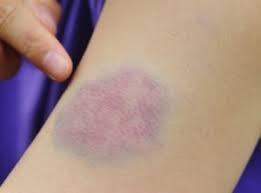 When purpura spots are less than 2 mm in diameter, they are called. Bruising Can Be A Manifestation Of Ehlers Danlos Syndrome Edsawareness Com