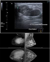 Surgical margins of >1 cm have been associated with lower local . Phyllodes Tumor Of The Breast Diagnosis Management And Outcome Durin Cmar