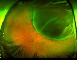 Retinal imaging takes a digital picture of the back of your eye. Ultra Widefield Imaging Can Enhance Efficiency For Practices