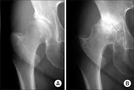 Press into the feet, lengthening the legs to press the hips up toward the ceiling. Radiographs Of A 56 Year Old Female Patient With Moderate Dysplasia Of Download Scientific Diagram