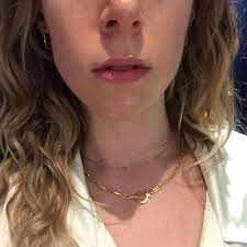 Exactly What To Expect From Lip Fillers Into The Gloss